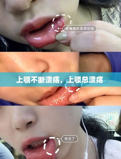 上顎不斷潰瘍，上顎總潰瘍 