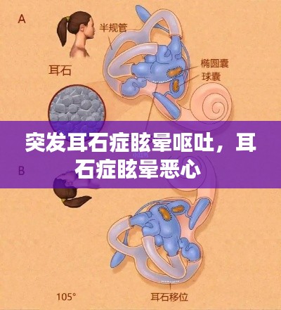 突發(fā)耳石癥眩暈嘔吐，耳石癥眩暈惡心 